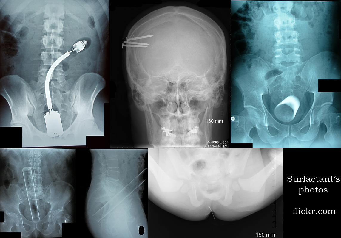 Érdekes röntgenképek - ciki helyzet